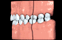 Animation of a class 1 bite with spaced teeth
