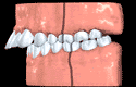 Animation of a class 2 bite with the upper jaw and teeth protruding out over