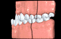 Animation of a class 3 bite with the lower jaw and teeth protruding past the upper jaw and teeth