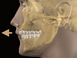 Animated Maxillary Dental Protrusion teeth