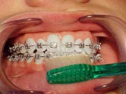 A person with braces having the bottom of their bottom teeth brushed