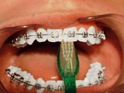 An example of brushing the gum line behind the upper front teeth