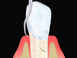 An animated illustration showing the process of root planing to clean and smooth the surface of the tooth root