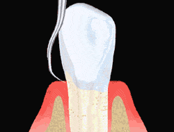 An animated illustrion showing the process of scaling to clean a tooth