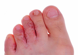 An example of a foot showing athlete's foot