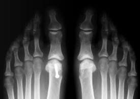 Photo: An x-ray of the feet showing the inflamed big toe joints and skeletal structure