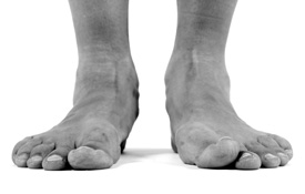Photo of bare feet with bunions
