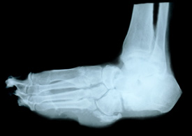 An x-ray of a foot with a warped foot structure caused by charcot foot