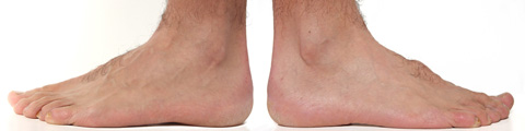 Photo: An example of feet with a hammer toe, as seen from the side of the foot