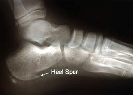 An x-ray of a foot showing an example of a heel spur