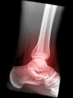 An x-ray of the ankle area