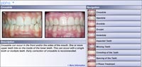 Classification of Teeth